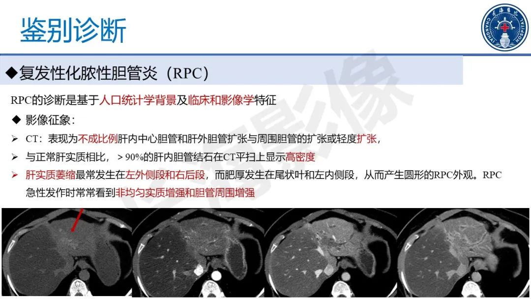 影像PPT - 【PPT】原发性硬化性胆管炎-44