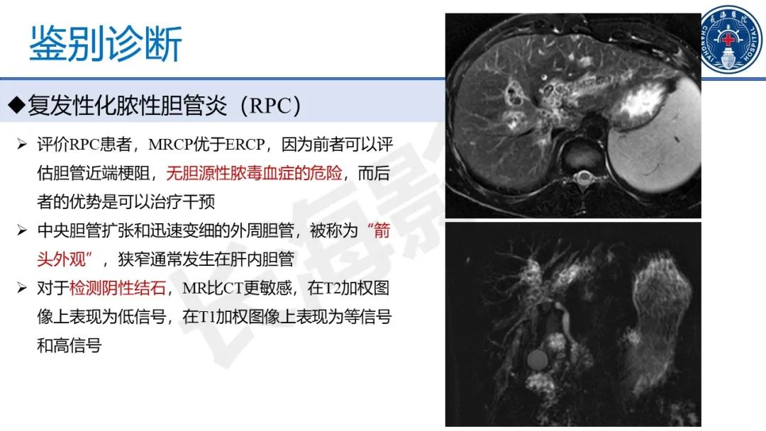 影像PPT - 【PPT】原发性硬化性胆管炎-45