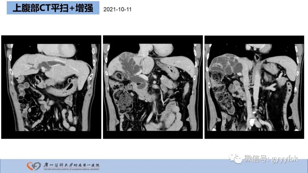 影像PPT - 【PPT】胆管导管内乳头状肿瘤-5
