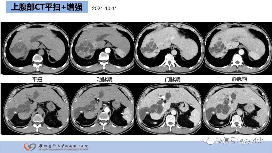 影像PPT - 【PPT】胆管导管内乳头状肿瘤-4