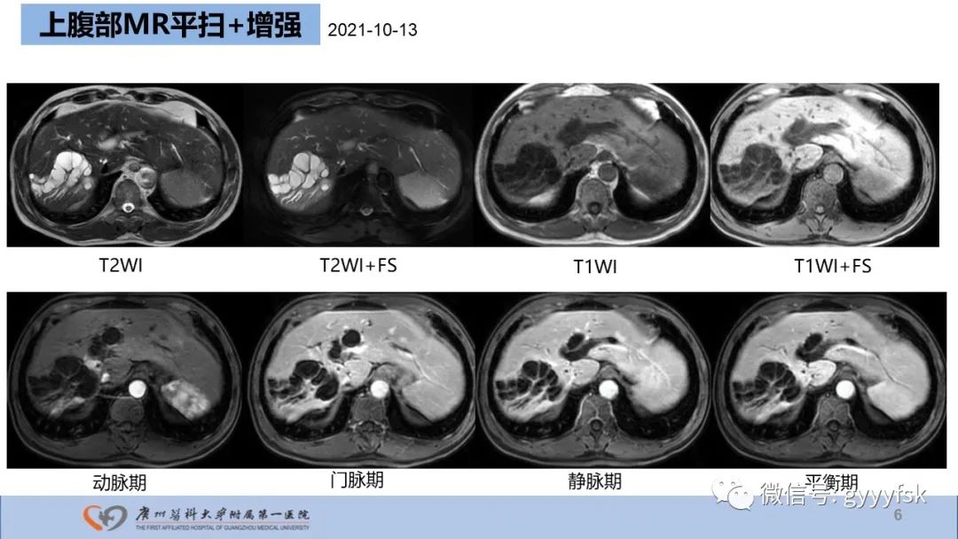 影像PPT - 【PPT】胆管导管内乳头状肿瘤-6