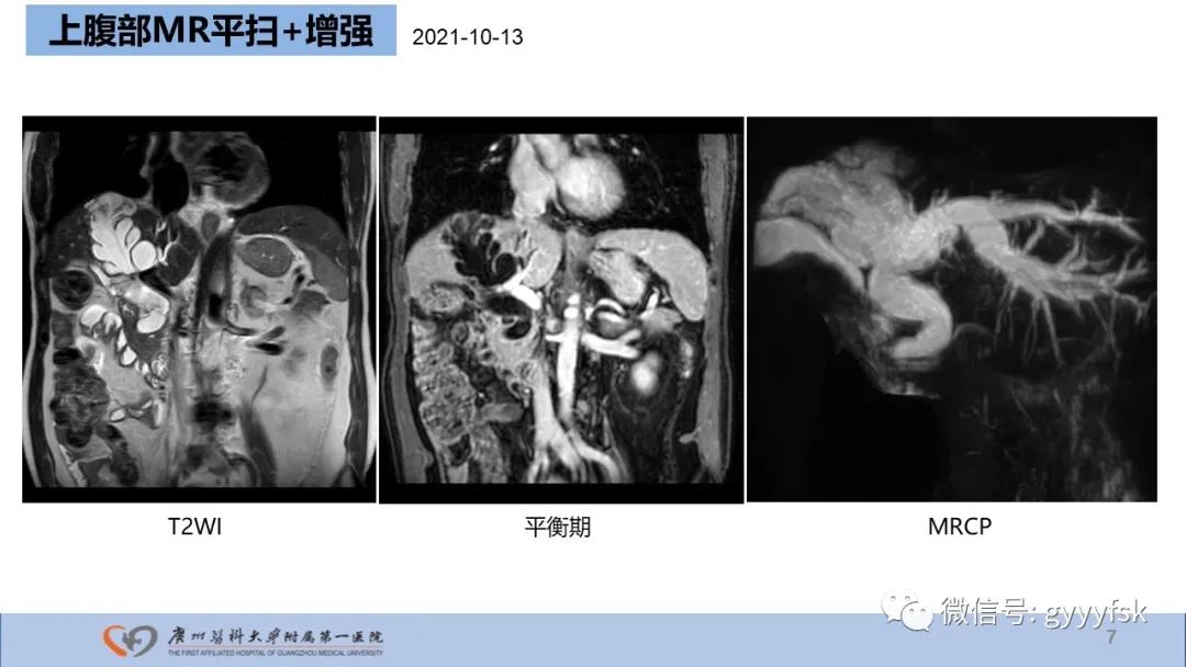 影像PPT - 【PPT】胆管导管内乳头状肿瘤-7