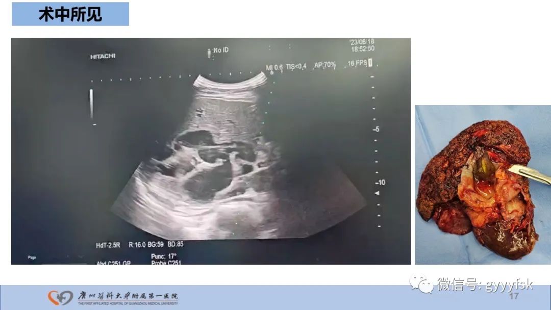 影像PPT - 【PPT】胆管导管内乳头状肿瘤-17