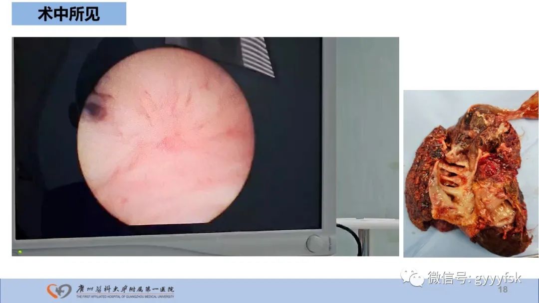 影像PPT - 【PPT】胆管导管内乳头状肿瘤-18
