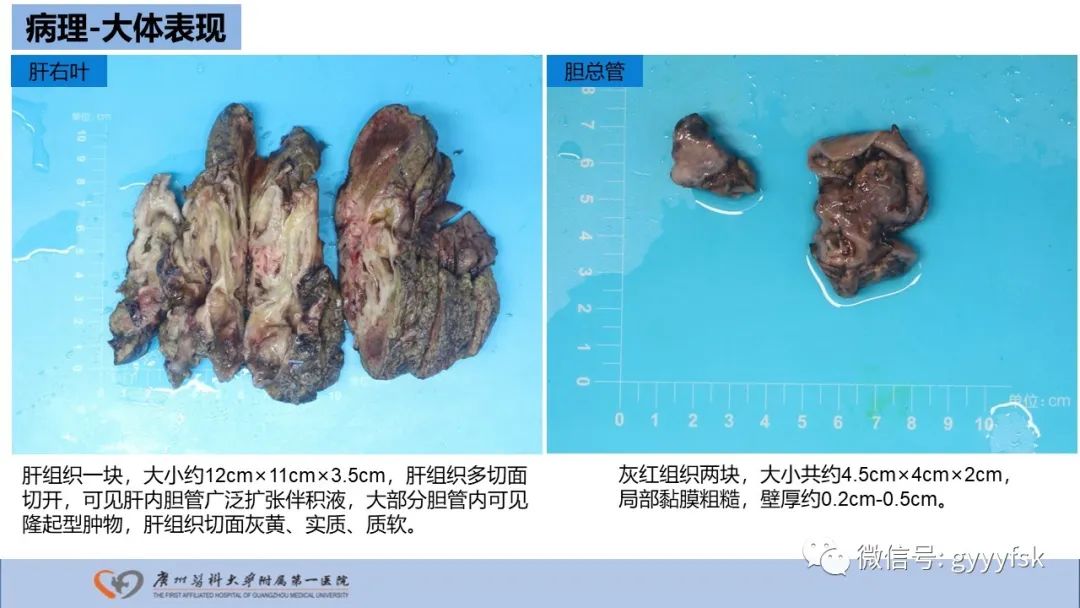 影像PPT - 【PPT】胆管导管内乳头状肿瘤-19