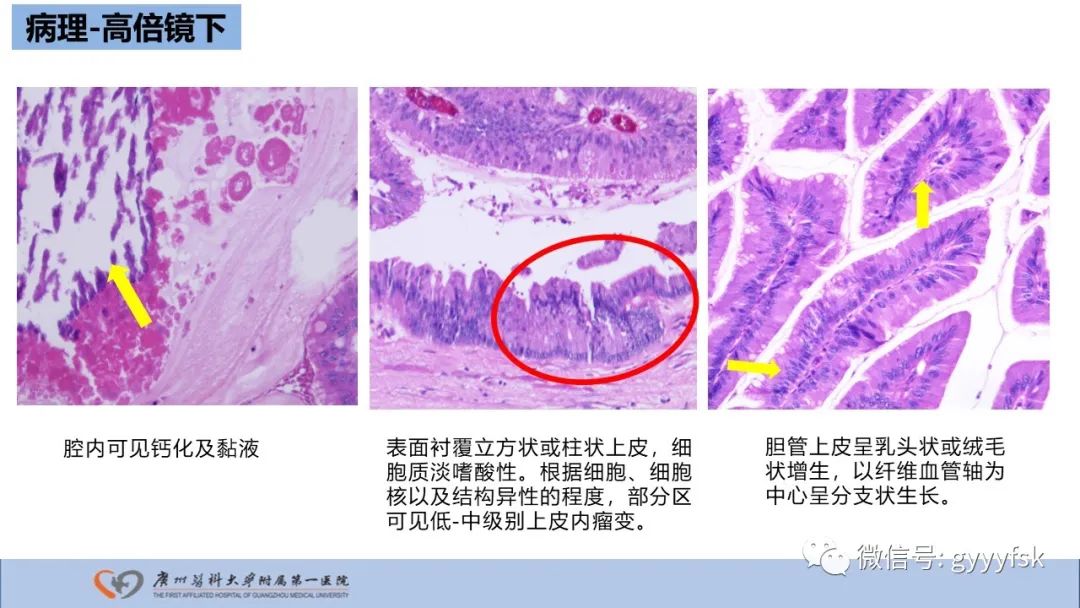 影像PPT - 【PPT】胆管导管内乳头状肿瘤-21