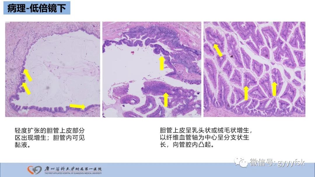 影像PPT - 【PPT】胆管导管内乳头状肿瘤-20