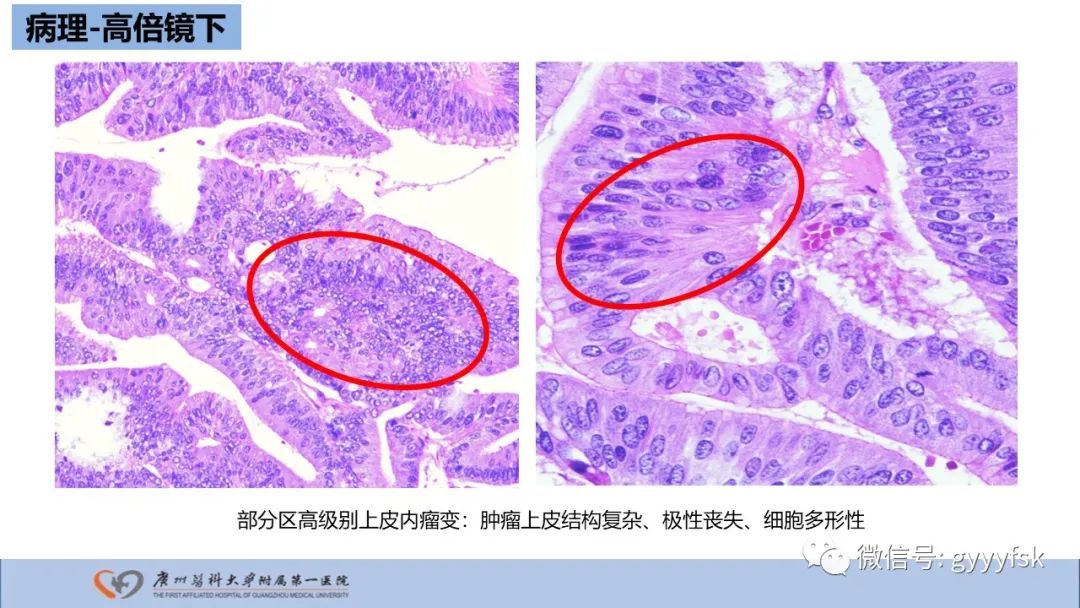 影像PPT - 【PPT】胆管导管内乳头状肿瘤-22