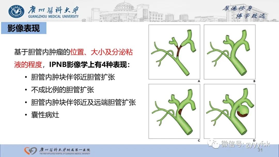 影像PPT - 【PPT】胆管导管内乳头状肿瘤-31