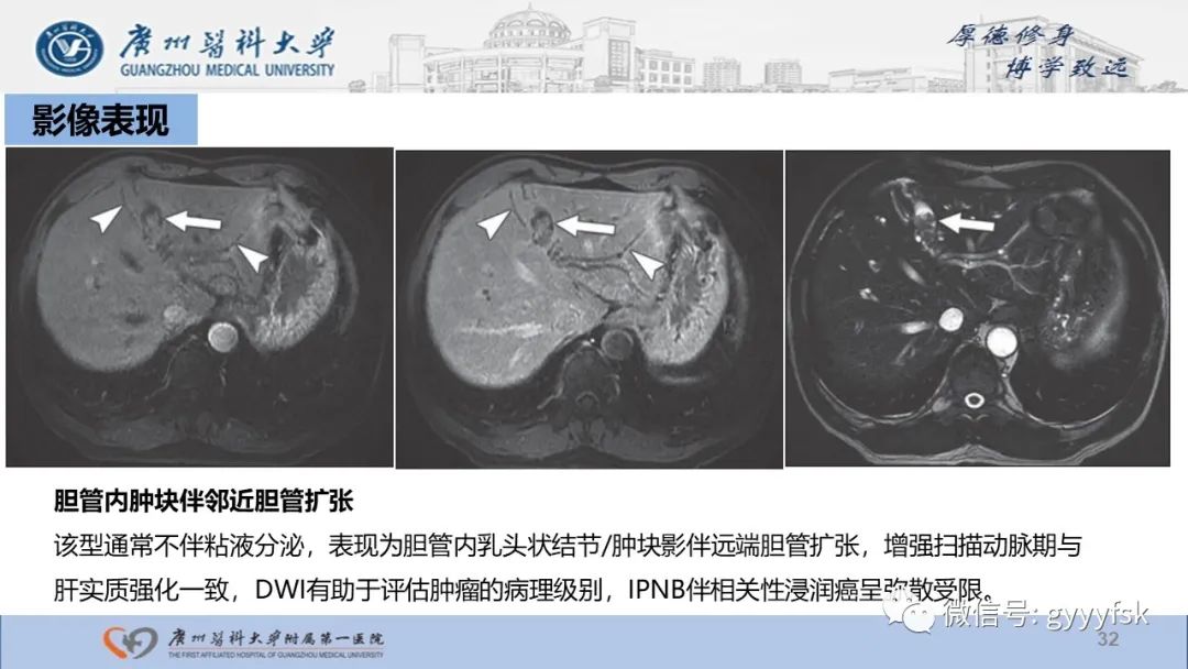 影像PPT - 【PPT】胆管导管内乳头状肿瘤-32