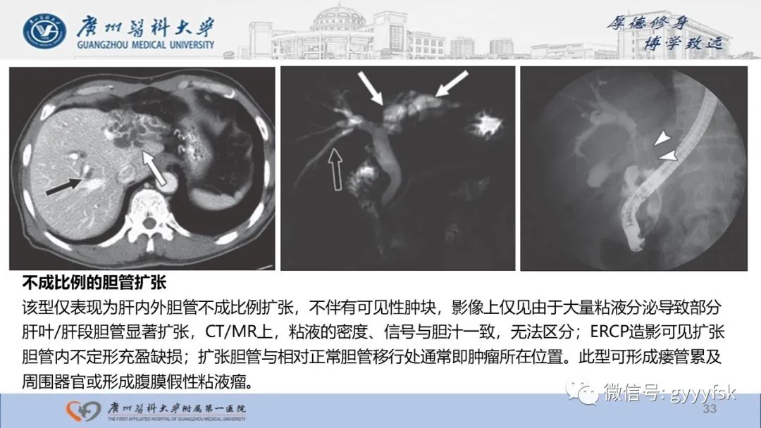 影像PPT - 【PPT】胆管导管内乳头状肿瘤-33