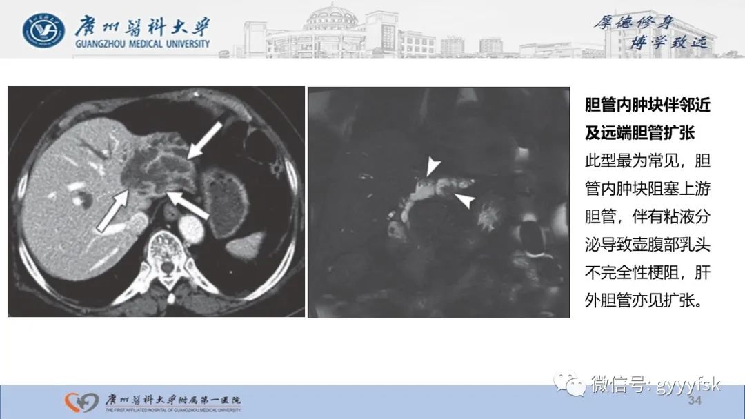 影像PPT - 【PPT】胆管导管内乳头状肿瘤-34