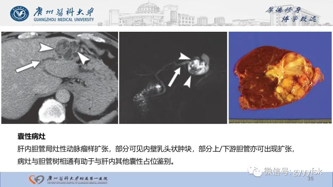 影像PPT - 【PPT】胆管导管内乳头状肿瘤-35