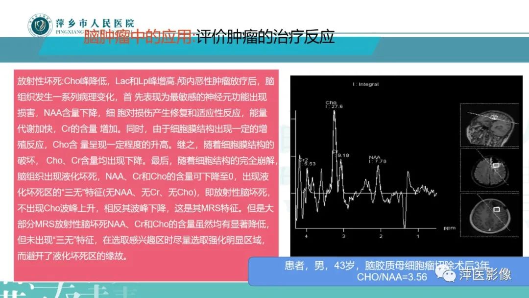 影像PPT - 【PPT】浅析脑肿瘤波谱成像-25