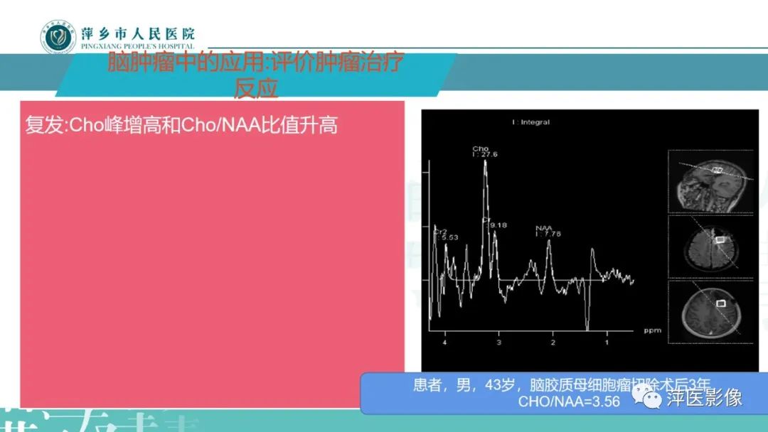 影像PPT - 【PPT】浅析脑肿瘤波谱成像-26