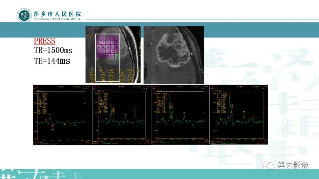 影像PPT - 【PPT】浅析脑肿瘤波谱成像-28