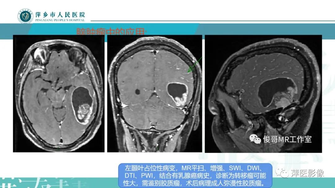 影像PPT - 【PPT】浅析脑肿瘤波谱成像-33