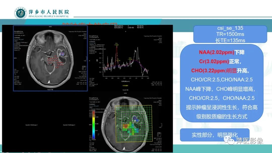 影像PPT - 【PPT】浅析脑肿瘤波谱成像-39