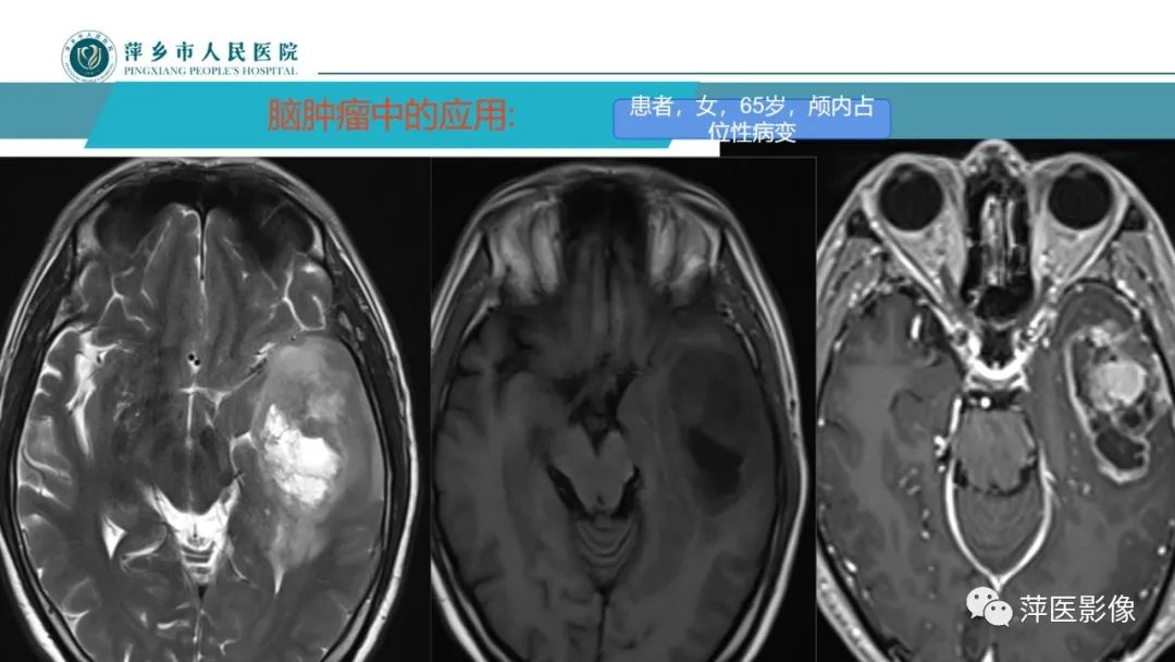 影像PPT - 【PPT】浅析脑肿瘤波谱成像-38