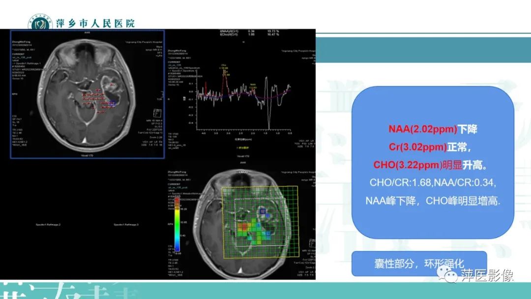 影像PPT - 【PPT】浅析脑肿瘤波谱成像-40