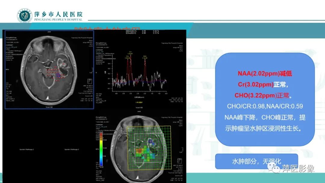 影像PPT - 【PPT】浅析脑肿瘤波谱成像-41