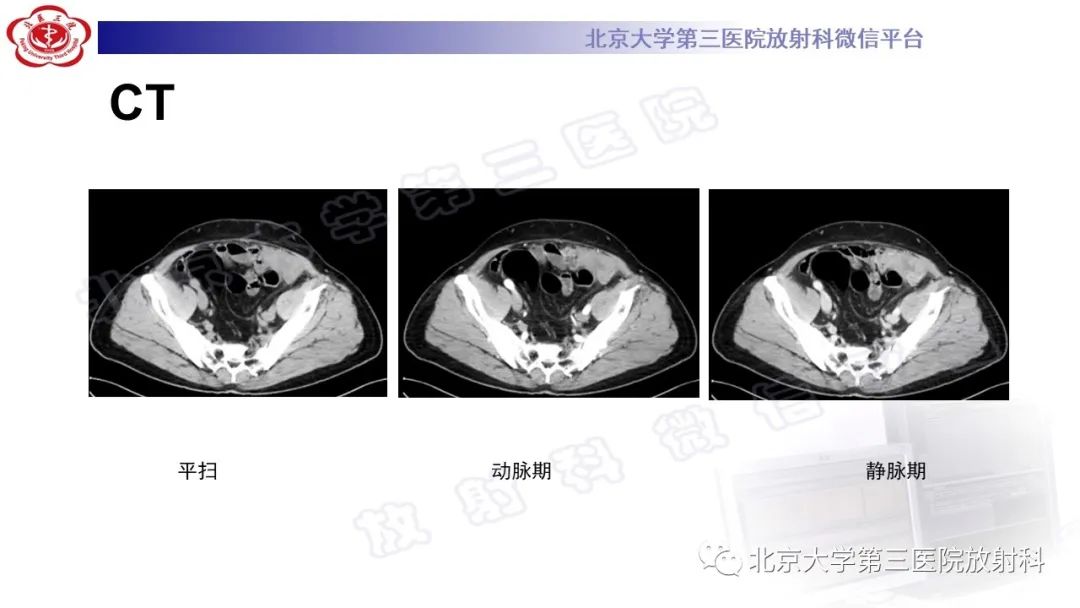 影像PPT - 【PPT】精原细胞瘤-3
