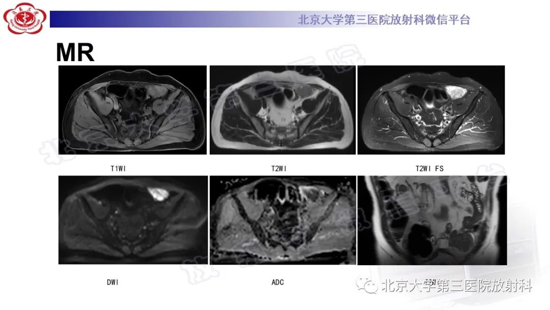 影像PPT - 【PPT】精原细胞瘤-6
