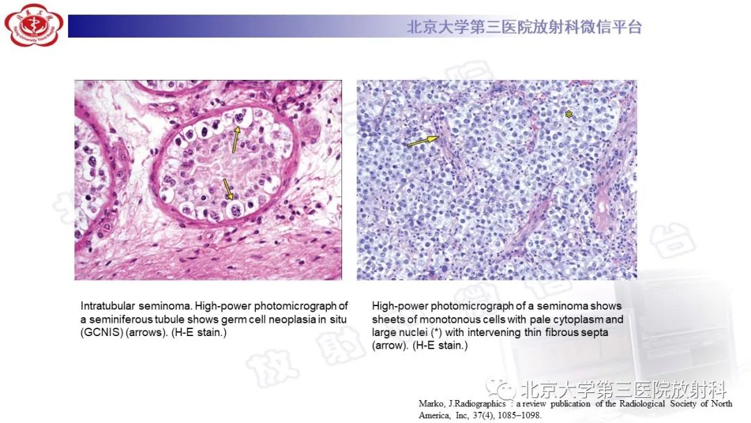 影像PPT - 【PPT】精原细胞瘤-17