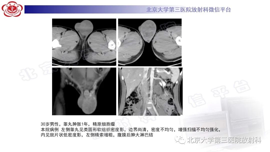 影像PPT - 【PPT】精原细胞瘤-19