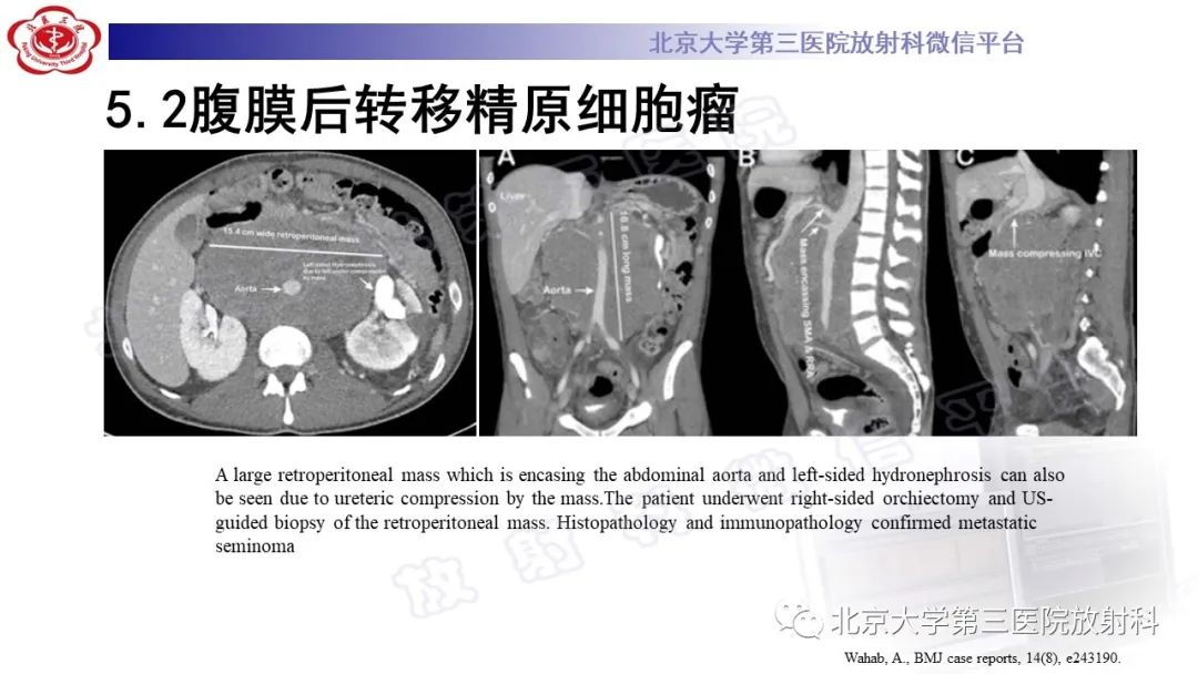 影像PPT - 【PPT】精原细胞瘤-23