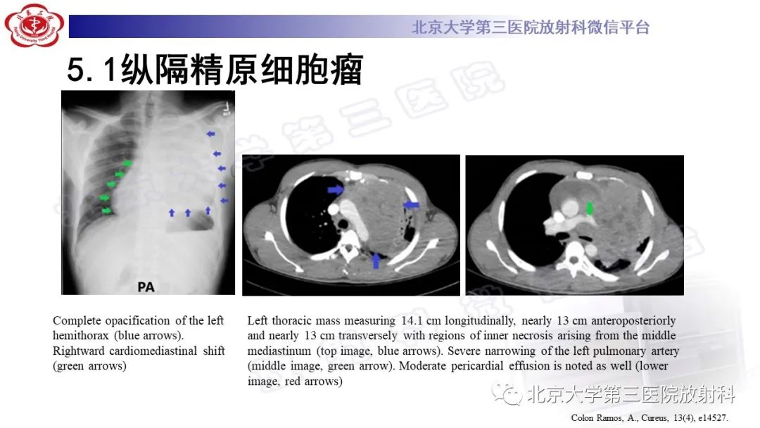 影像PPT - 【PPT】精原细胞瘤-22
