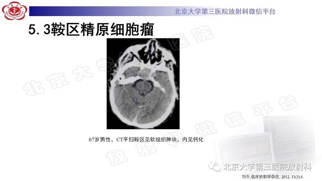 影像PPT - 【PPT】精原细胞瘤-24