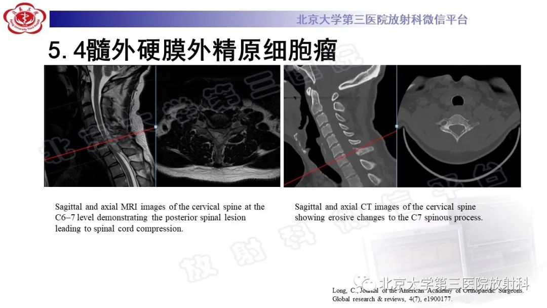 影像PPT - 【PPT】精原细胞瘤-25