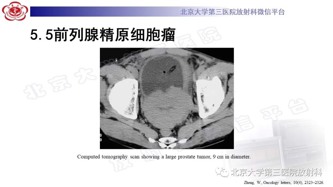影像PPT - 【PPT】精原细胞瘤-26