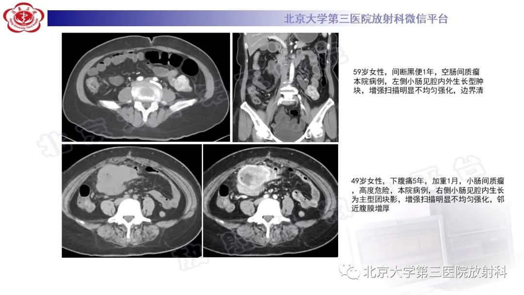 影像PPT - 【PPT】精原细胞瘤-29