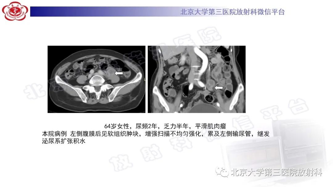 影像PPT - 【PPT】精原细胞瘤-31