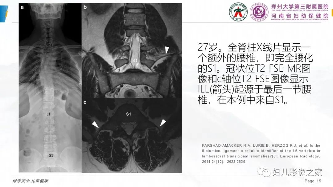 影像PPT - 【PPT】椎体定位与计数—再认识-14