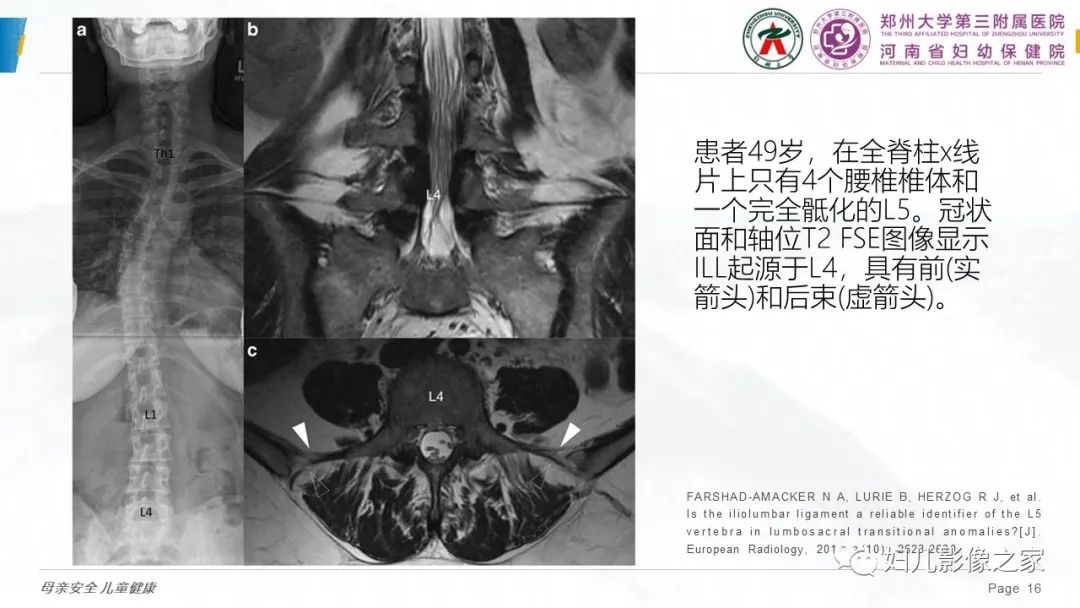 影像PPT - 【PPT】椎体定位与计数—再认识-15