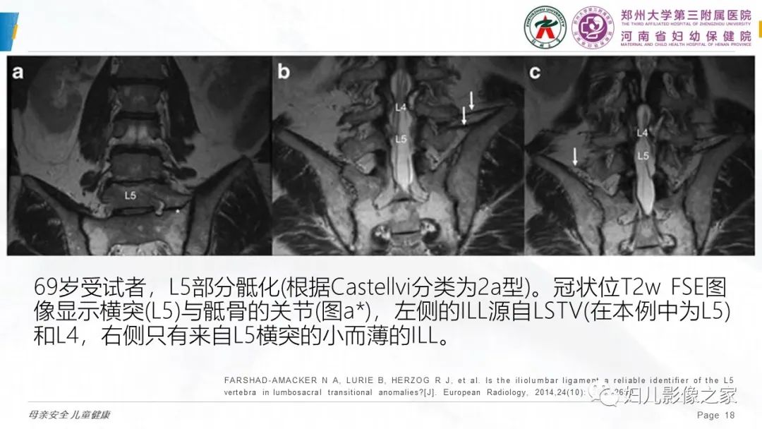 影像PPT - 【PPT】椎体定位与计数—再认识-17