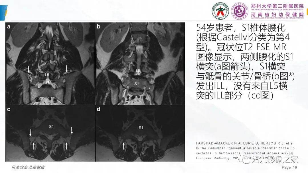影像PPT - 【PPT】椎体定位与计数—再认识-18