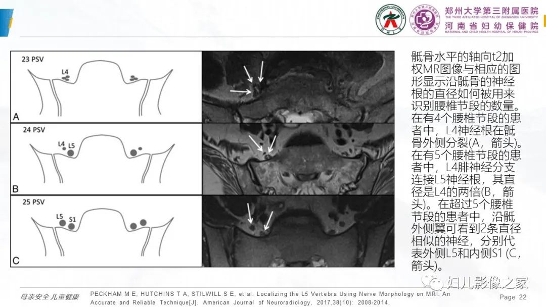影像PPT - 【PPT】椎体定位与计数—再认识-21