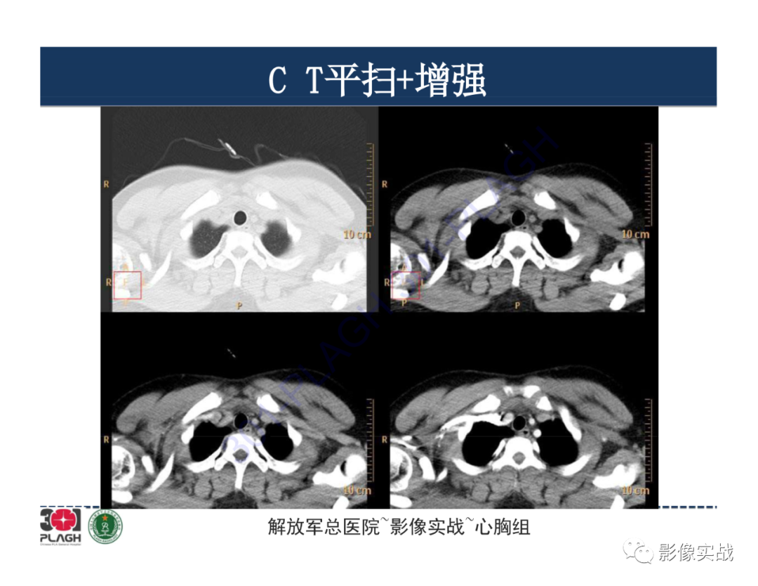 影像PPT - 【病例】前纵隔畸胎瘤1例CT影像-3