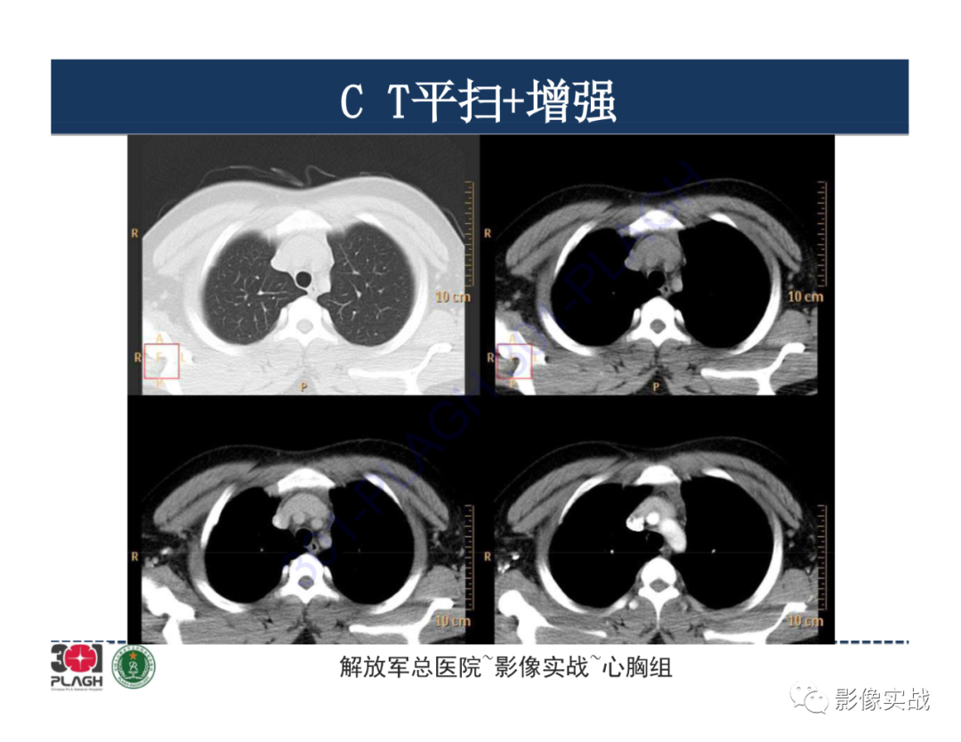 影像PPT - 【病例】前纵隔畸胎瘤1例CT影像-4