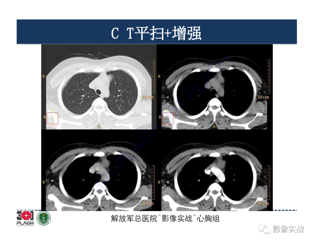 影像PPT - 【病例】前纵隔畸胎瘤1例CT影像-5