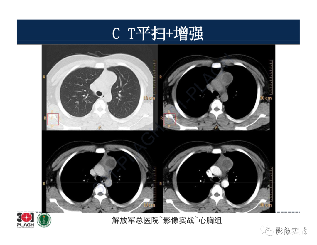 影像PPT - 【病例】前纵隔畸胎瘤1例CT影像-6