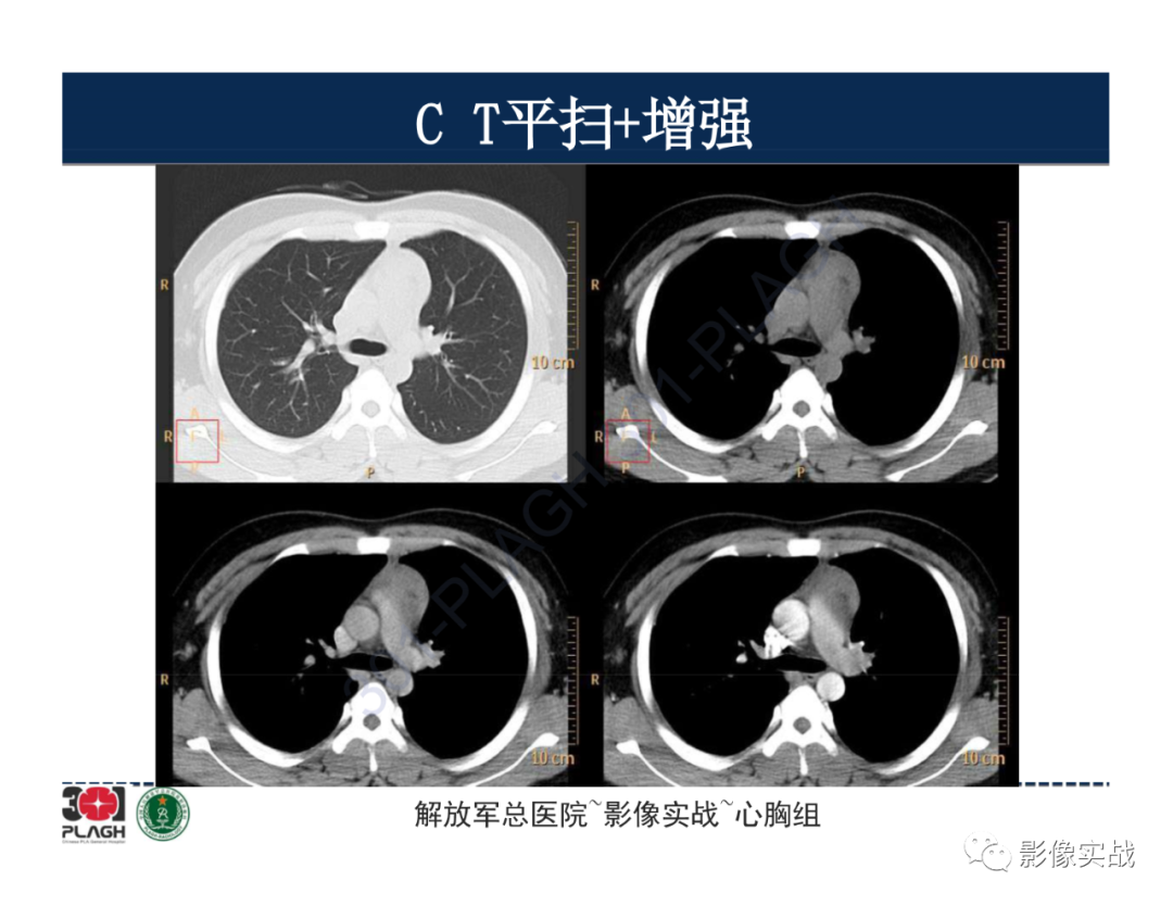 影像PPT - 【病例】前纵隔畸胎瘤1例CT影像-7