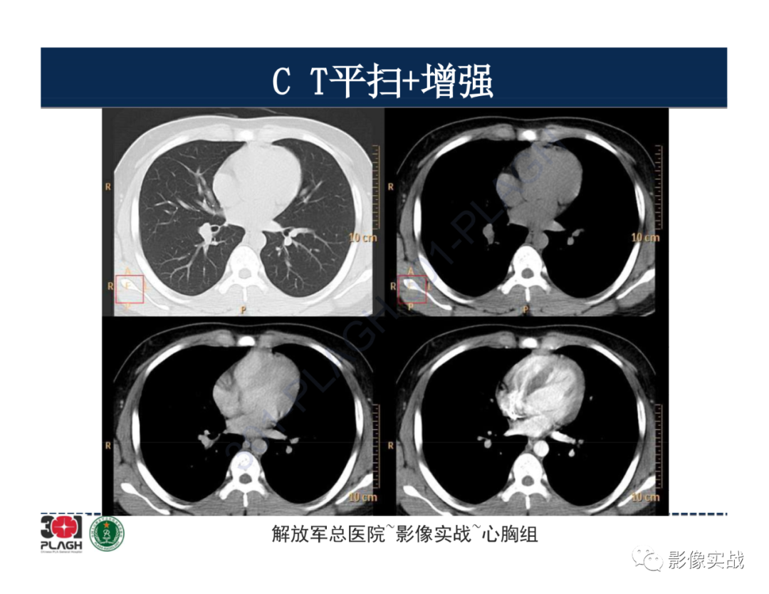 影像PPT - 【病例】前纵隔畸胎瘤1例CT影像-8