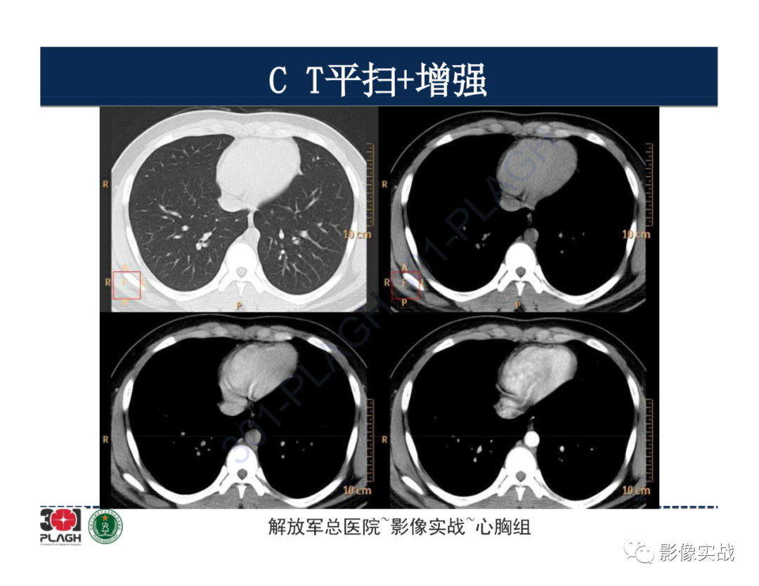 影像PPT - 【病例】前纵隔畸胎瘤1例CT影像-9
