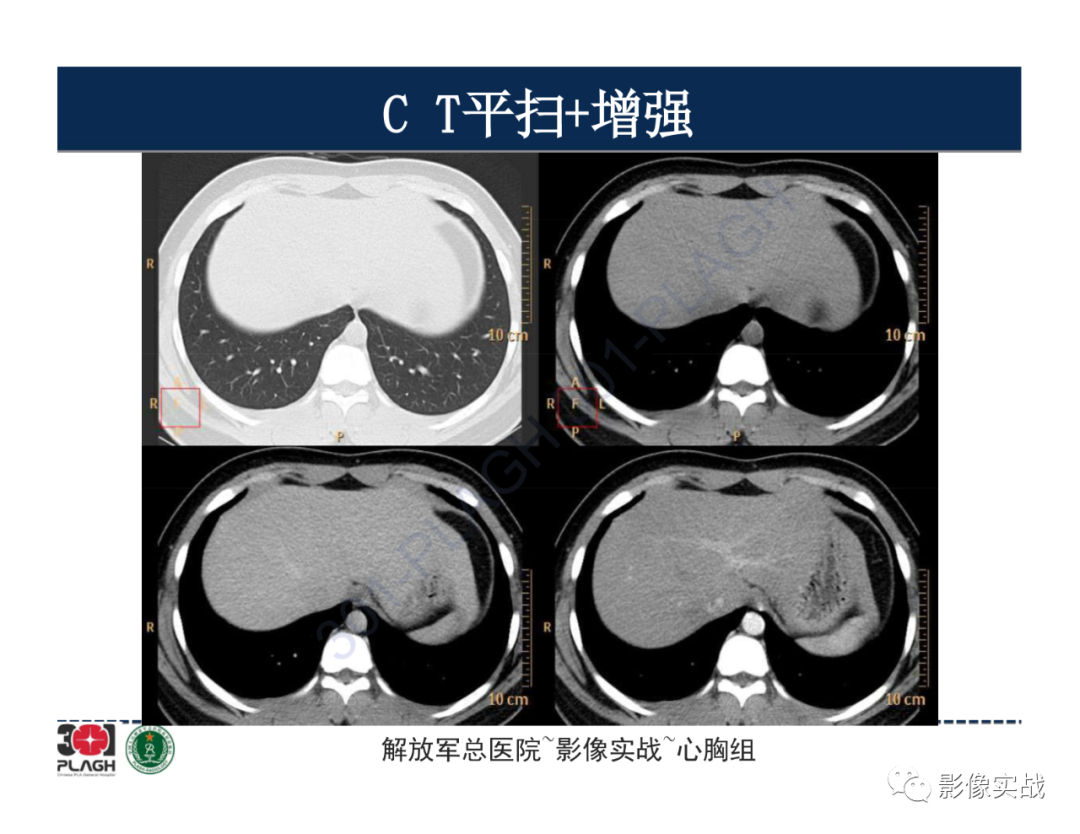 影像PPT - 【病例】前纵隔畸胎瘤1例CT影像-10