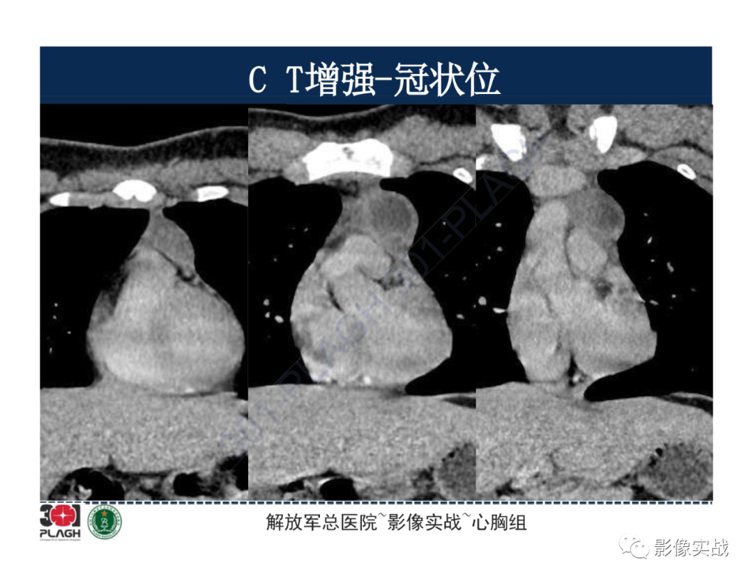 影像PPT - 【病例】前纵隔畸胎瘤1例CT影像-11